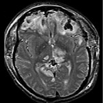 Indirect Effects Of A TBI